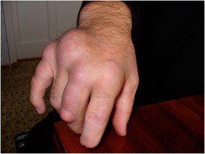 Питание при подагре на пальцах рук