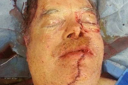 Мужчина распилил себе лицо бензопилой и сам добрался до врачей