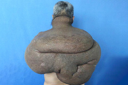 Мужчина десятки лет растил на спине 15-килограммовую опухоль
